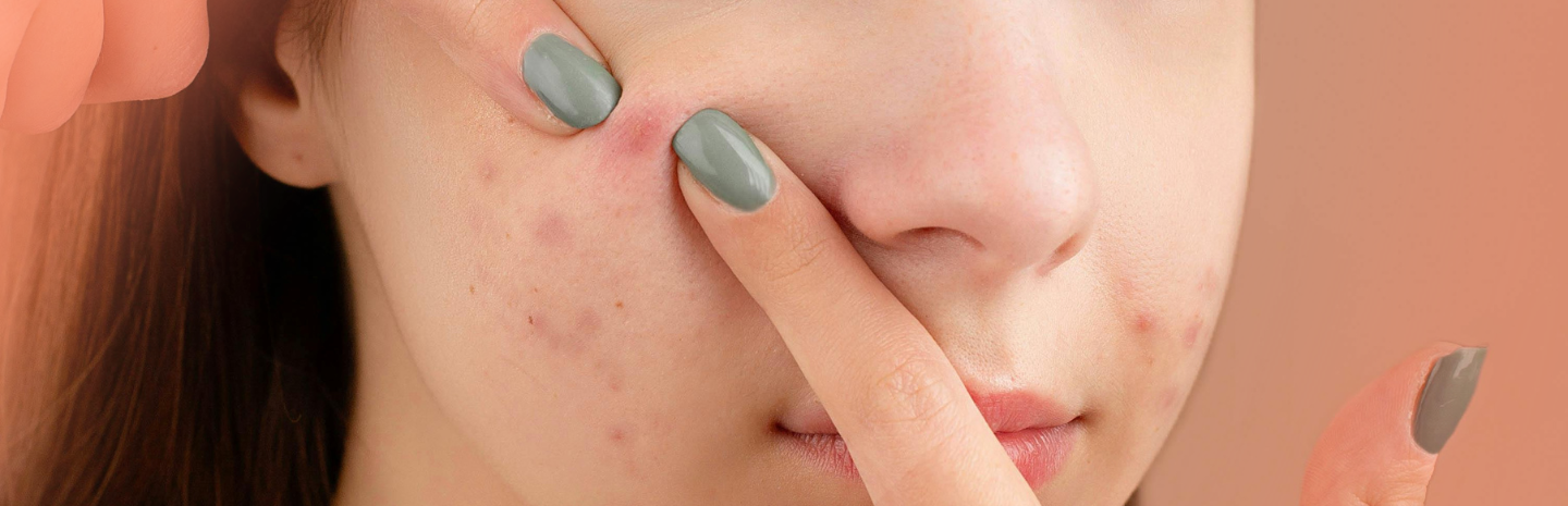 Skin Breakout | Skincare Routine | Period Acne | Acne Before Period | Period Acne Location | Skincare Routine For Pimples